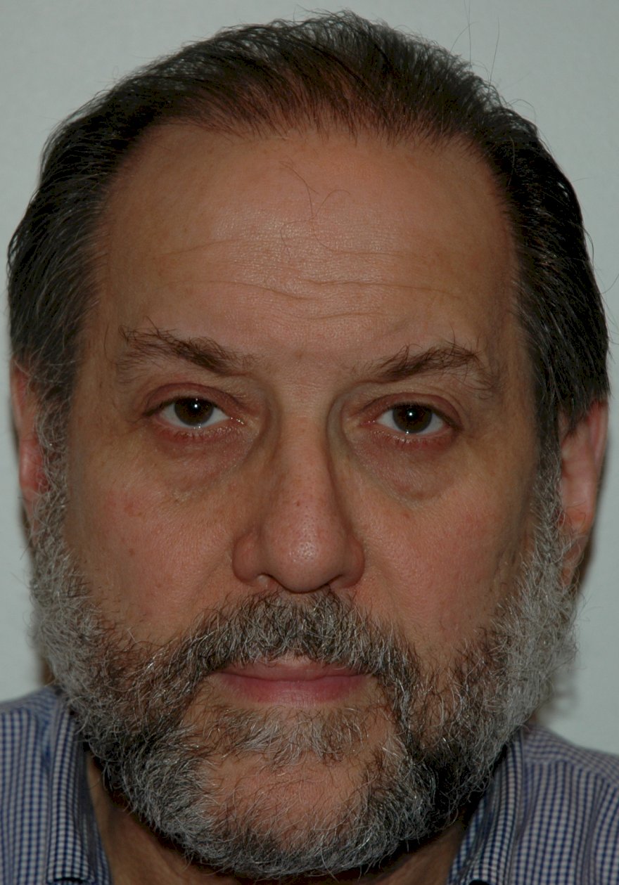 Hair Transplantation in Turkiye