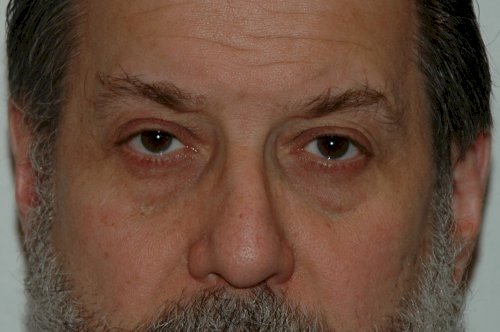 Hair Transplantation in Turkiye