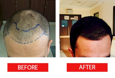 Fue Method Hair Transplantation in Istanbul Turkiye